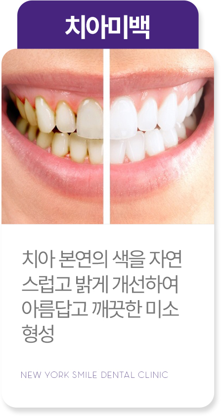 사랑니발치